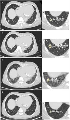 Comparison of different therapeutic approaches for pulmonary cryptococcosis in kidney transplant recipients: a 15-year retrospective analysis